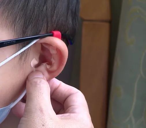 相结合,针感更强,效应时间更久,对近视防控具有较好的临床治疗效果,且