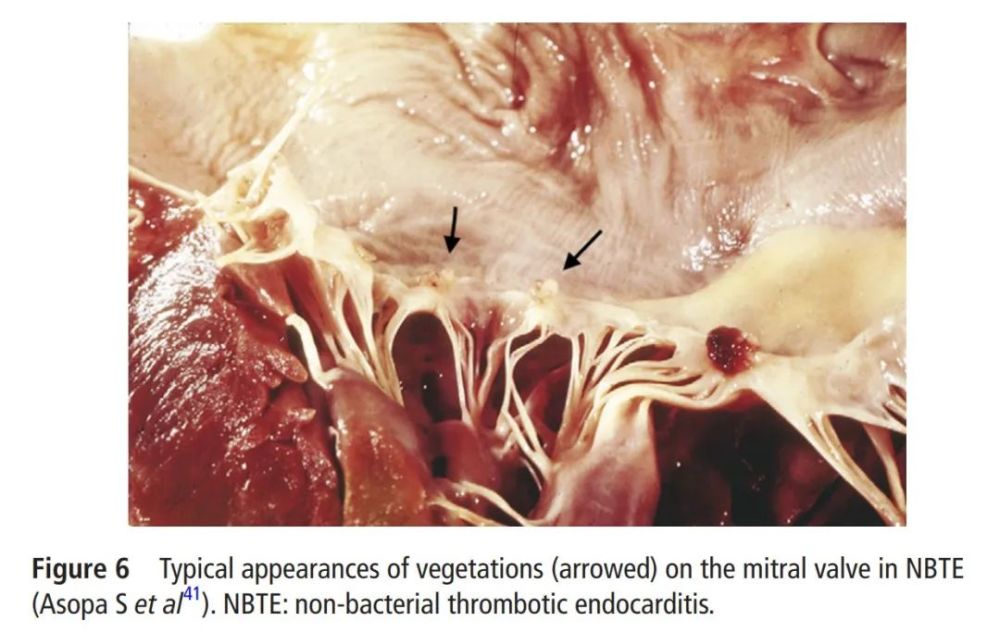 都可以导致非细菌性心内膜炎(nbte), 从而在二尖瓣和主动