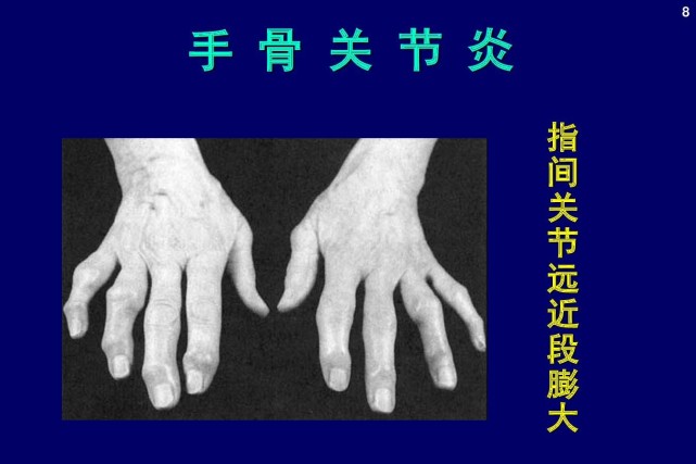 类风湿关节炎和普通的骨关节炎,如何区分?