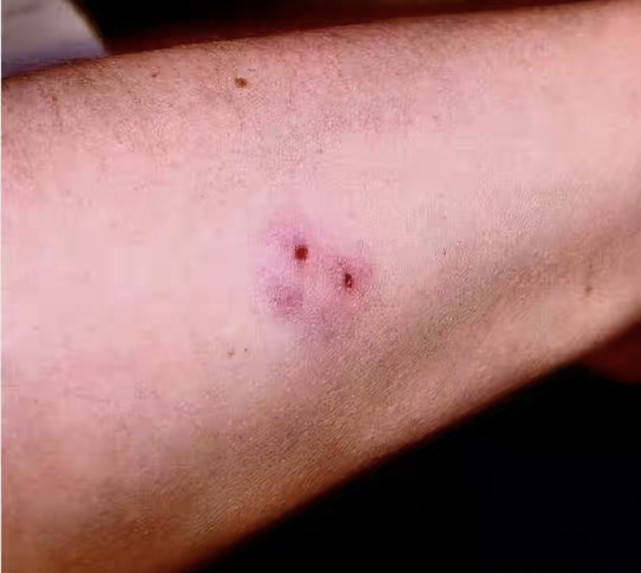 小区惊现银环蛇衡阳女子扔垃圾时被咬伤夏季究竟该如何防蛇