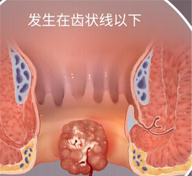 直肠和肛管的交界线称为齿状线,肛门癌便是发生在齿状线下方,以肛门为