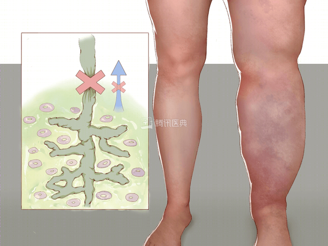 是由于先天性淋巴管发育不良或继发性淋巴液回流障碍,导致肢体浅层软
