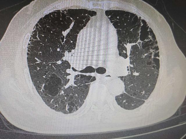 ct上满肺都是大泡泡,原因居然和这个有关