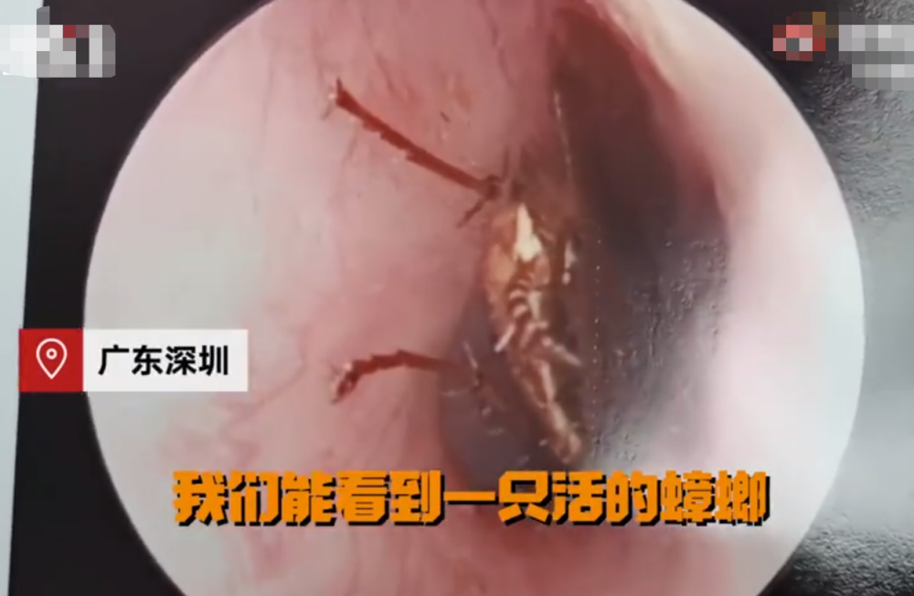 吓人6岁女童耳内竟取出一只蟑螂医生处理不慎可致鼓膜穿孔