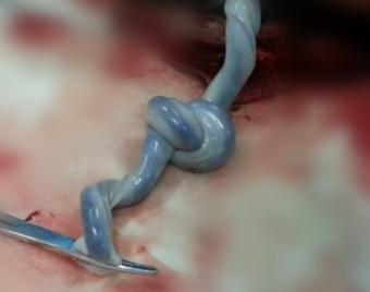 相对于脐带绕颈,脐带打结则比较少见一旦发现需要及时到医院就诊,在