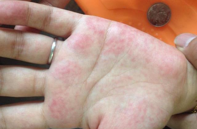 了损伤,通常红斑出现密集的地方就是我们的手掌心,一般会称之为肝掌