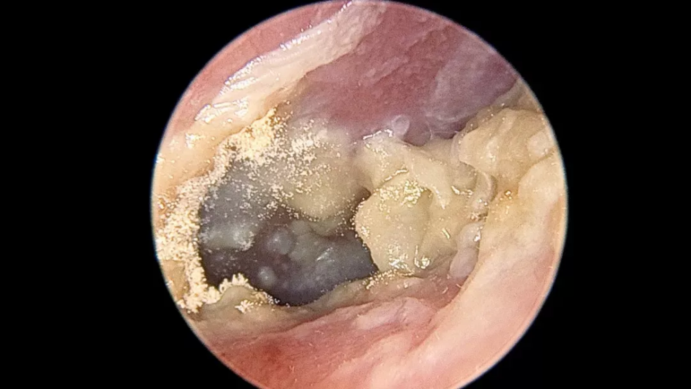 街边的采耳别乱试耳朵能长霉你敢信