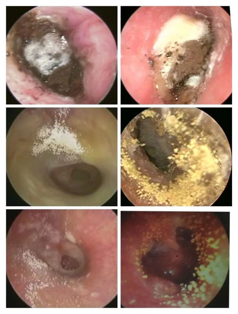 耳朵霉菌图片大全图片