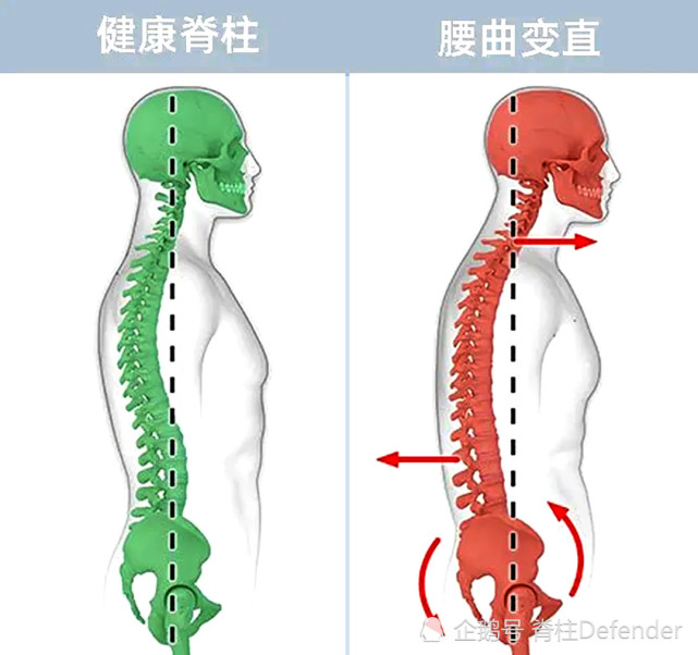 腰椎曲度變直了,還有可能恢復嗎?