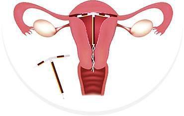 关于上环,你想知道的都在这