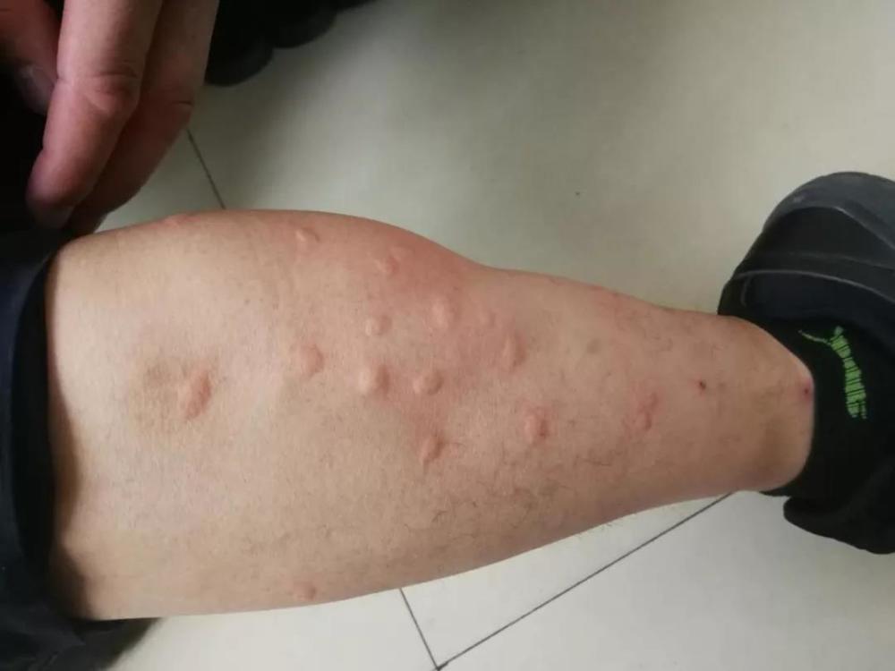 看着身上被咬的密密麻麻的鼓包他们说那是蚊子窝送的荣誉勋章