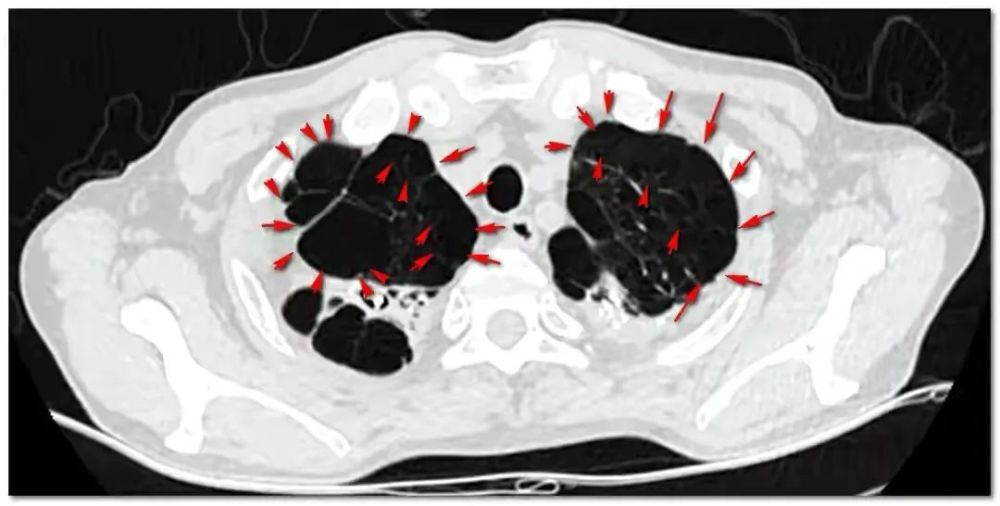 65岁老汉烂肺一年 炸 六次 上厕所再次破裂 胸部插管化险为夷 全网搜