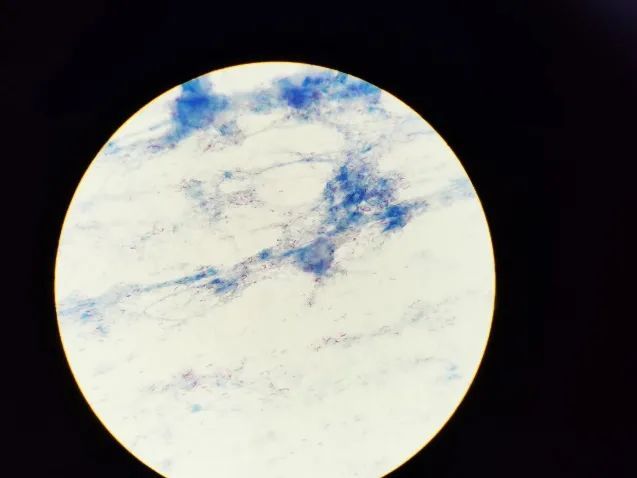 穿刺液呈血性,实验室进行革兰染色,抗酸染色,细菌培养等检测,革兰染色