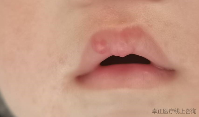 宝宝嘴唇长包1个月了还没消散是咋回事
