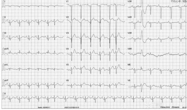 7份r波递增不良心电图你能全部识别吗