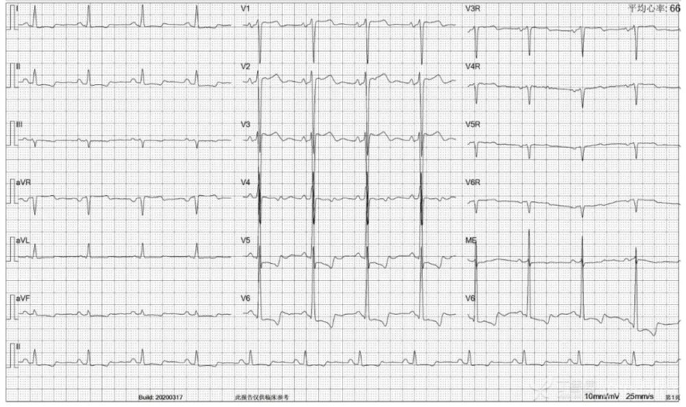 7份r 波递增不良心电图,你能全部识别吗?