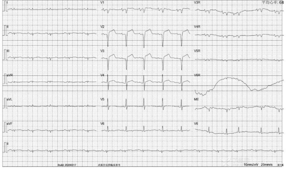 7份r 波递增不良心电图,你能全部识别吗?