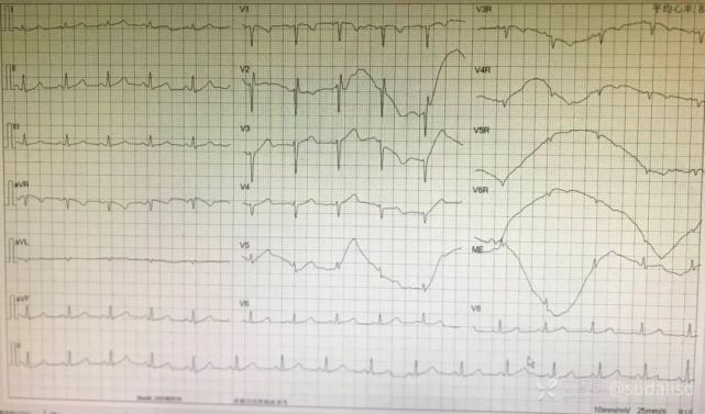 7份r 波递增不良心电图,你能全部识别吗?