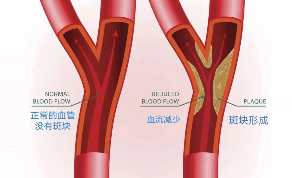 中药颈部动脉斑块治疗方法_中药颈部动脉治疗斑块方法_中药颈部动脉治疗斑块方法图片