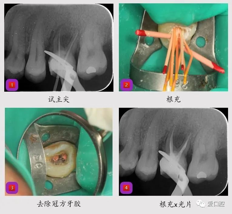 第六次治疗:26上障,去除暂封物,疏通根管,重测根管长度mb=17mm,db=