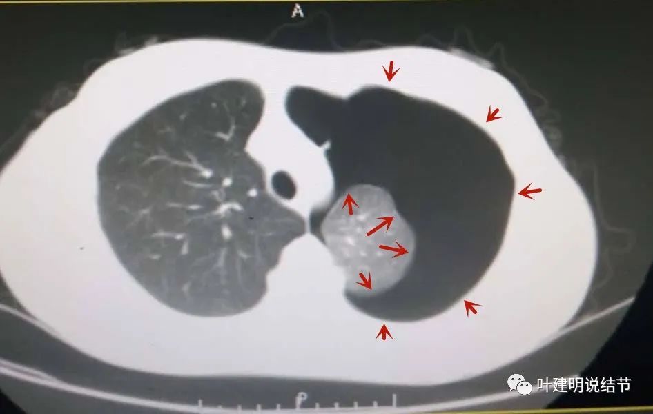 百姓科普 21 8 29 肺大泡都要手术吗 腾讯新闻