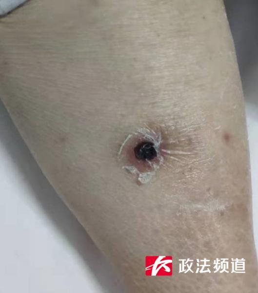 七旬老人反复高热不退竟是被这种小虫给咬了