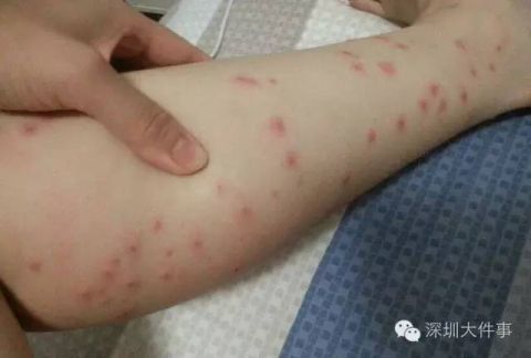 目前我国并没怎么发现蠓传给人的疾病大部分在动物之间传播 丝虫病