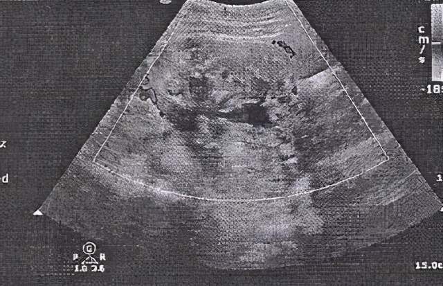 她的右侧附件区有大小70*76mn的囊肿经过b超检查发现前不久,张阿姨