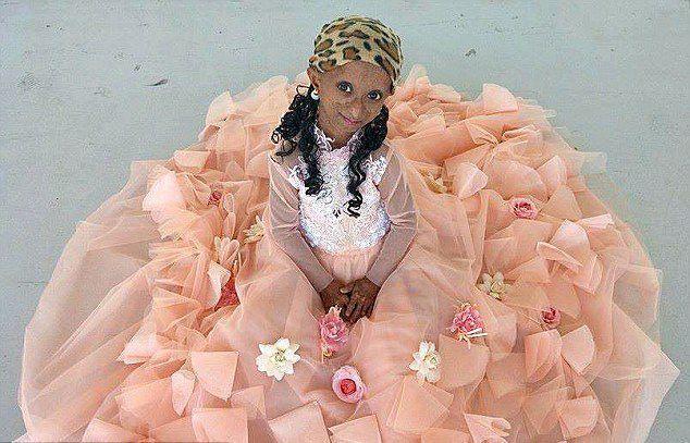 花季少女患怪病早衰症身体年龄达144岁