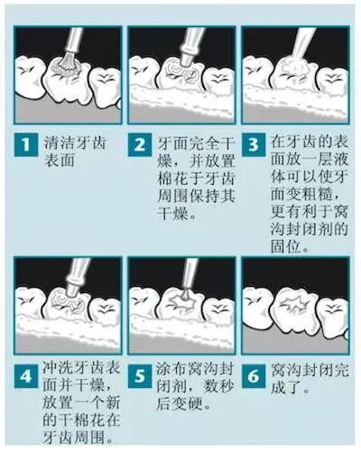 容易蛀牙的人,该如何做好龋齿预防?