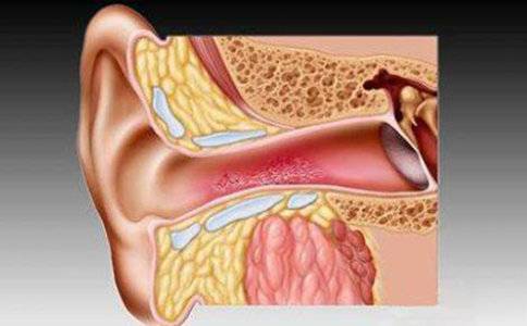 近日降雨频繁警惕恼人的真菌性外耳道炎
