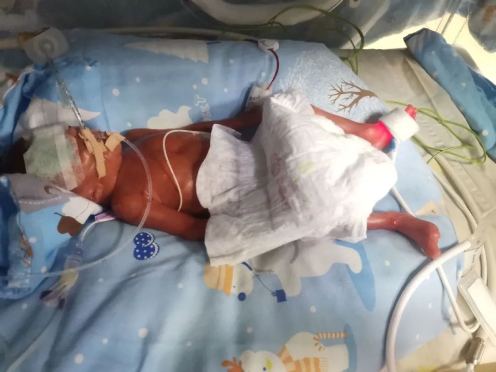 顺德一女子早产了6个月的巴掌小baby!在朋友圈刷爆了!