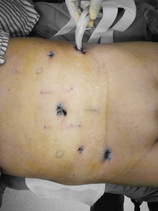 患者术后第1天就有肛门排气,第2天患者已下床活动,"我妈妈就好像做了