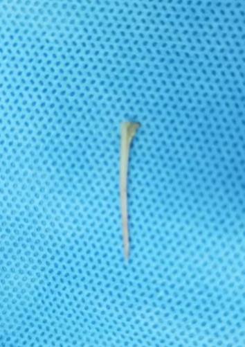 鱼刺卡喉用老土方专家不科学且危险