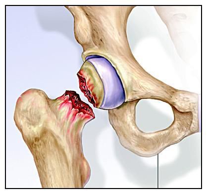 做好這幾件事,降低外傷性股骨頭壞死的發病幾率!