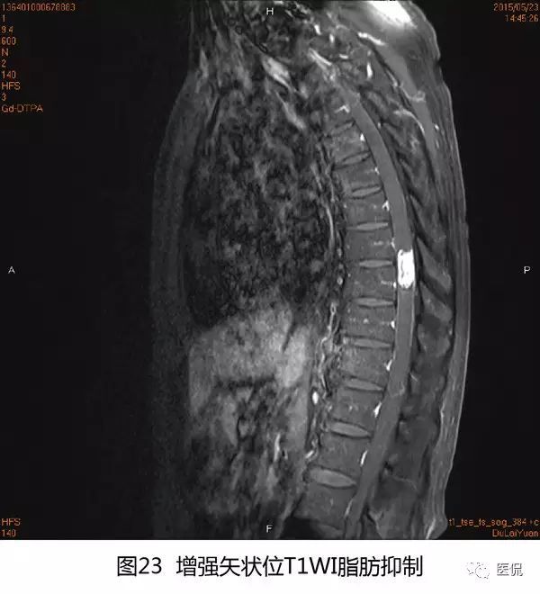 恶性脑瘤手术后活几年_小脑扁桃体下疝手术实人图片_小脑脑瘤手术后能活多久