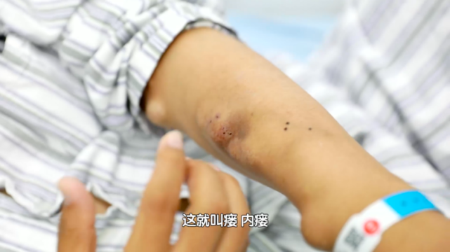 关于尿毒症病人有这样一种说法,透析五年,相当于人半截埋到了土里.