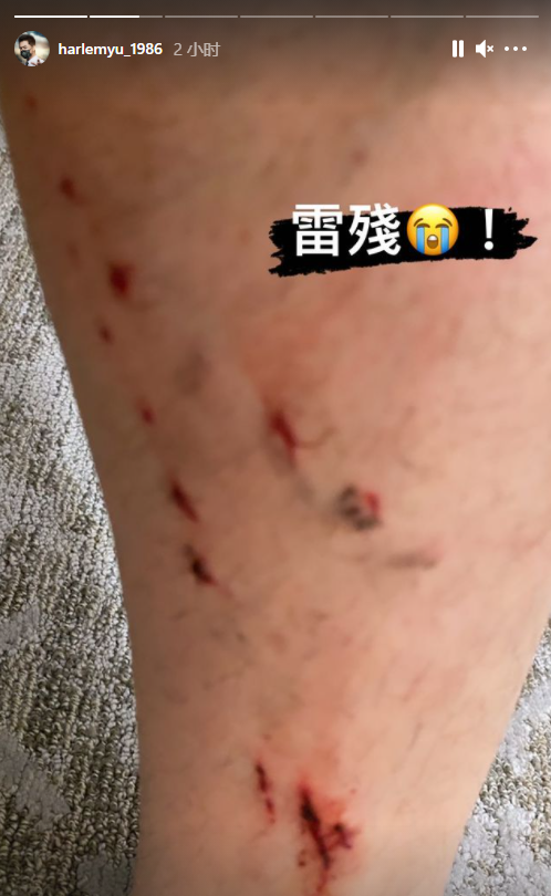 哈林騎單車摔倒致手腳流血,曬綁繃帶照惹人擔憂,經紀人回應傷勢