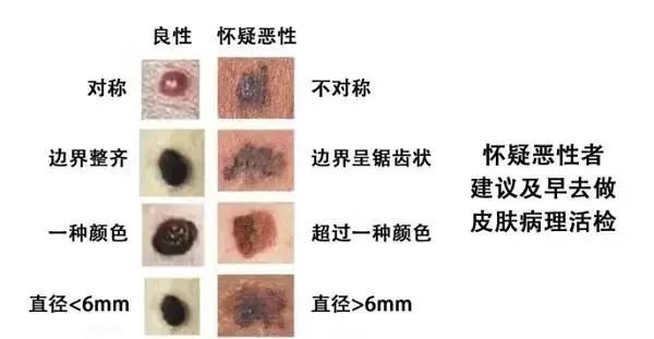 你知道什麼樣的痣容易癌變嗎