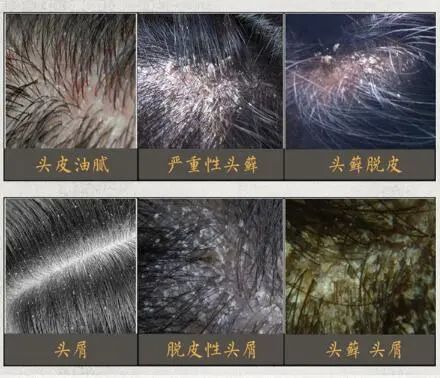 临床症状:碟状黄癣痂,成群红色小丘疹,密集小脓包,灰白色鳞屑圆形脱发