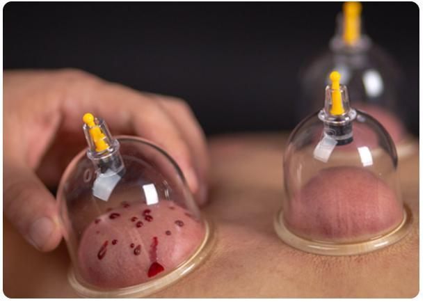 拔火罐时,后背出来的瘀血,是排出的毒素吗?大多数人还不了解