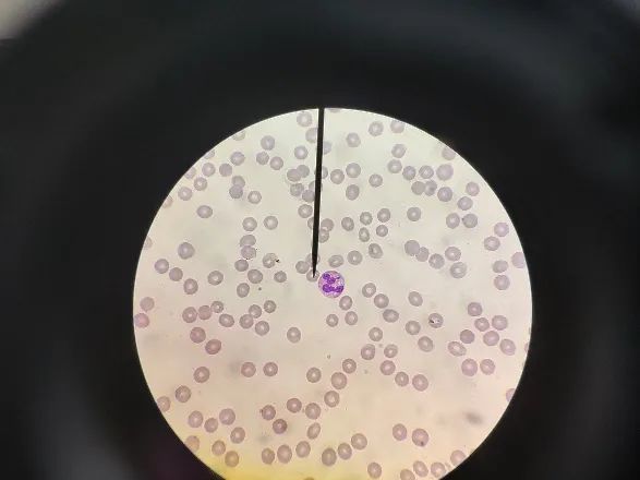 镜下白细胞数量与仪器相符,形态未见明显异常;红细胞淡染区扩大