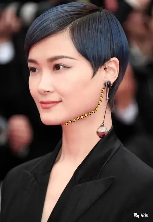 被切掉的下颌角如今又要补回来方脸不香吗