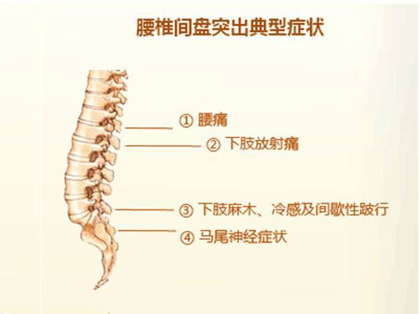 预防腰间盘突出,坐姿和站姿,你做对了吗