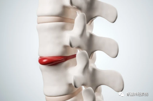 对于一些轻度的腰椎间盘膨出型患者,理论上可以通过正骨手法,牵引,吊