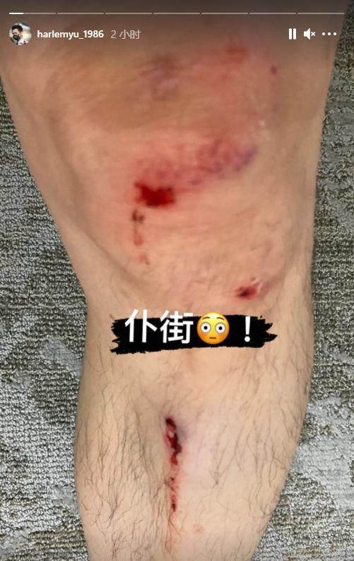 哈林騎單車摔倒致手腳流血曬綁繃帶照惹人擔憂經紀人回應傷勢