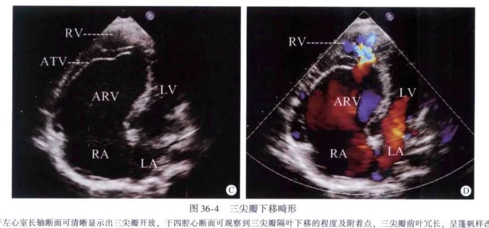 筆記分享:三尖瓣下移畸形_騰訊新聞