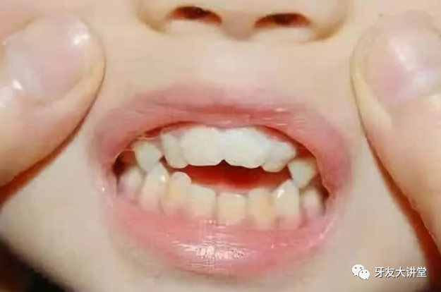 儿童有3次改变牙齿不齐的"黄金期,爸妈千万别错过!
