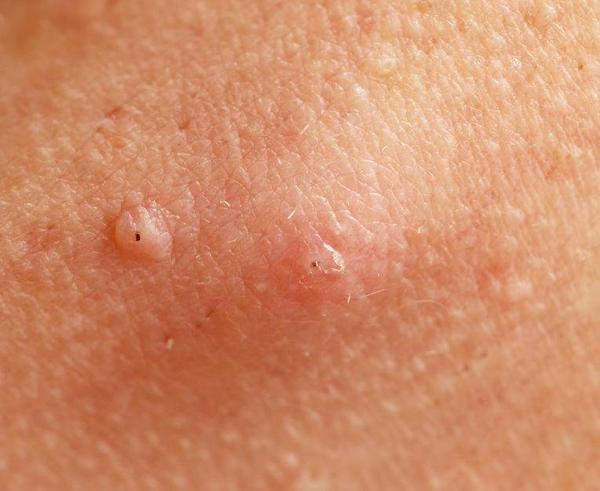 当毛囊炎到来时身体会出现4个表现留意到一个也要重视