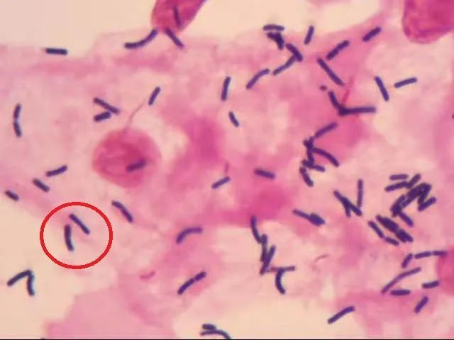 白带常规革兰染色等于阴道微生态检查让我来为你揭秘
